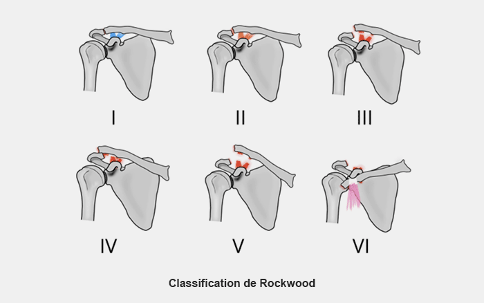 La classification se fait en 6 stades selon Rockwood