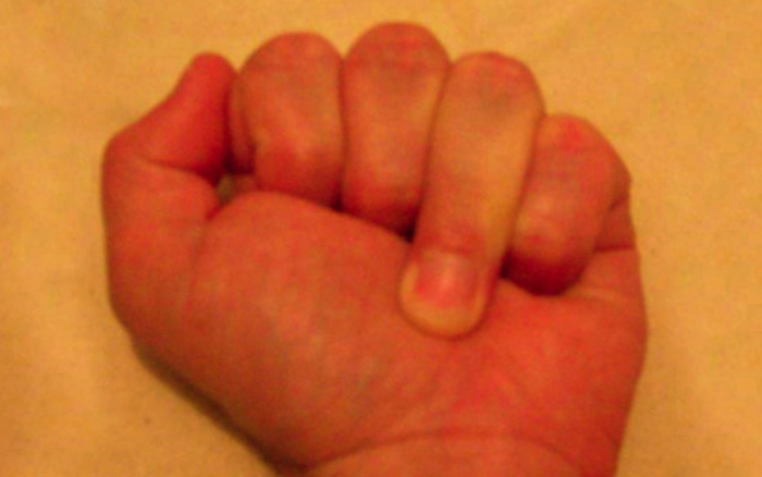Jersey finger : L’extrémité du doigt ne se fléchit plus car le tendon est arraché de son insertion