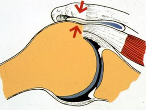 Conflit sous-acromial