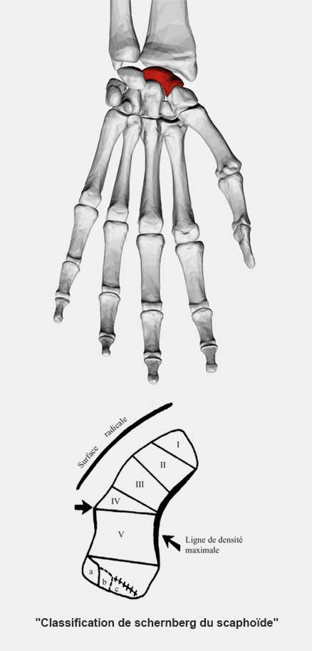 fracture-du-scaphoide-3D Classification de schernberg du scaphoïde