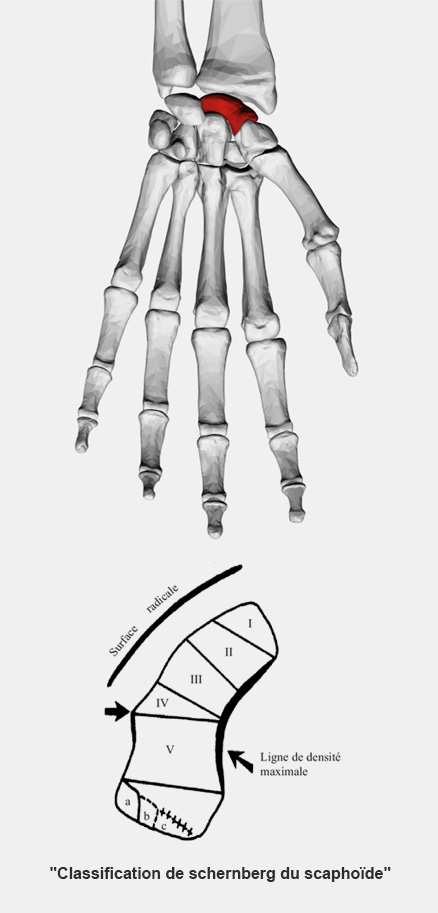 Classification de schernberg du scaphoïde