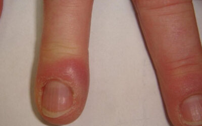 Panaris au doigt : causes, symptômes et traitements