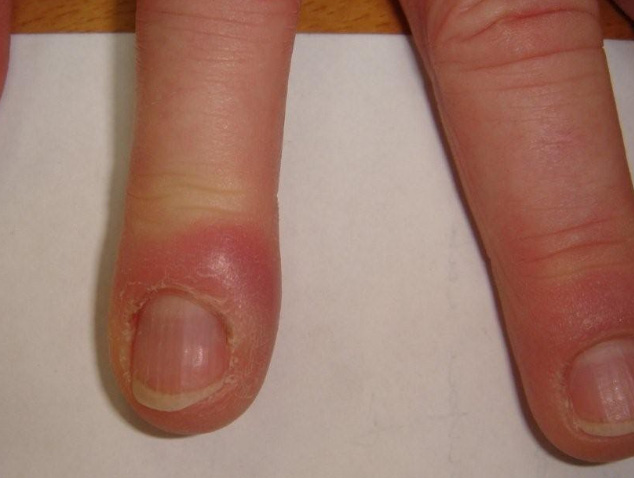 Panaris au doigt : causes, symptômes et traitements