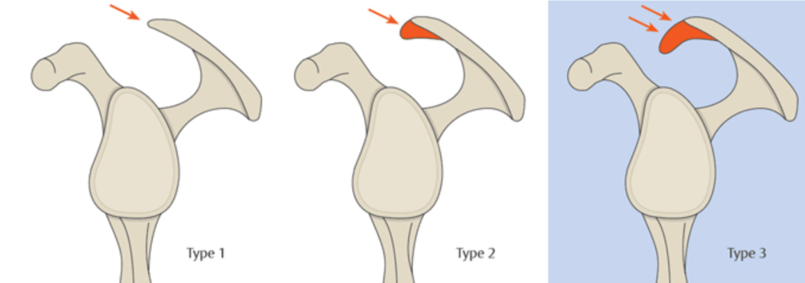 Classification de Bigliani des acromions “agressifs”