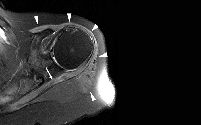 identifiée à l’IRM chez un patient souffrant du syndrome de Parsonage et Turner (d’après Le Hanneur et al., Neurosurgery 2018)