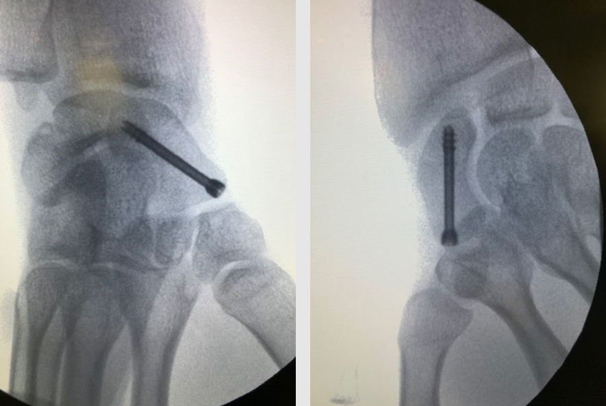 Le traitement chirurgical pour une fracture du scaphoïde