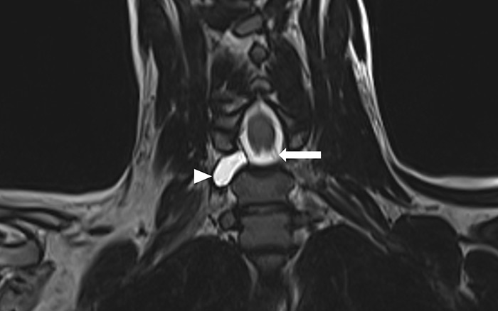 Patiente présentant une paralysie proximale étendue du plexus brachial droit à la suite d’un accident de moto, avec à l’IRM des signes en faveur d’un arrachement de la racine cervicale C6