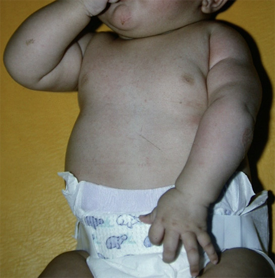 Nouveau-né présentant une paralysie néonatale du plexus brachial gauche de type I, avec paralysie de l’épaule et de la flexion du coude.