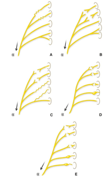 paralysie néonatale du plexus brachial 