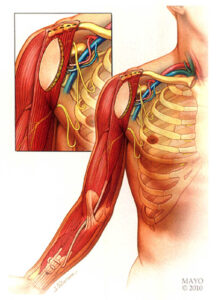 Paralysie du plexus brachial de l'adulte - Centre Main Epaule ...