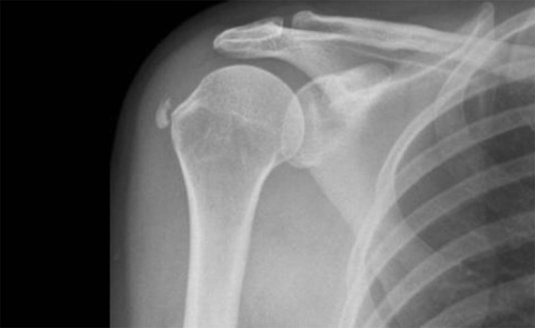 calcifications-epaule@2x Qu’est-ce qu’une calcification de l’épaule