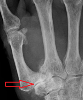 radiographie d’une rhizarthrose 