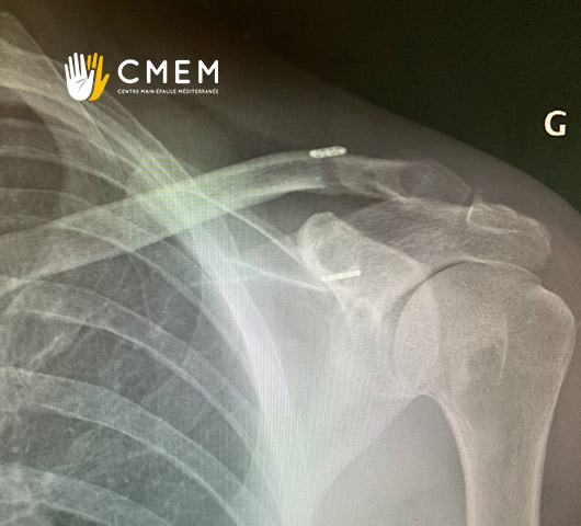 Fractures à l'épaule - Radiographie CMEM