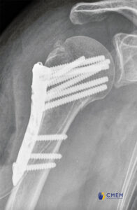 Radiographie Fracture de l'épaule CMEM