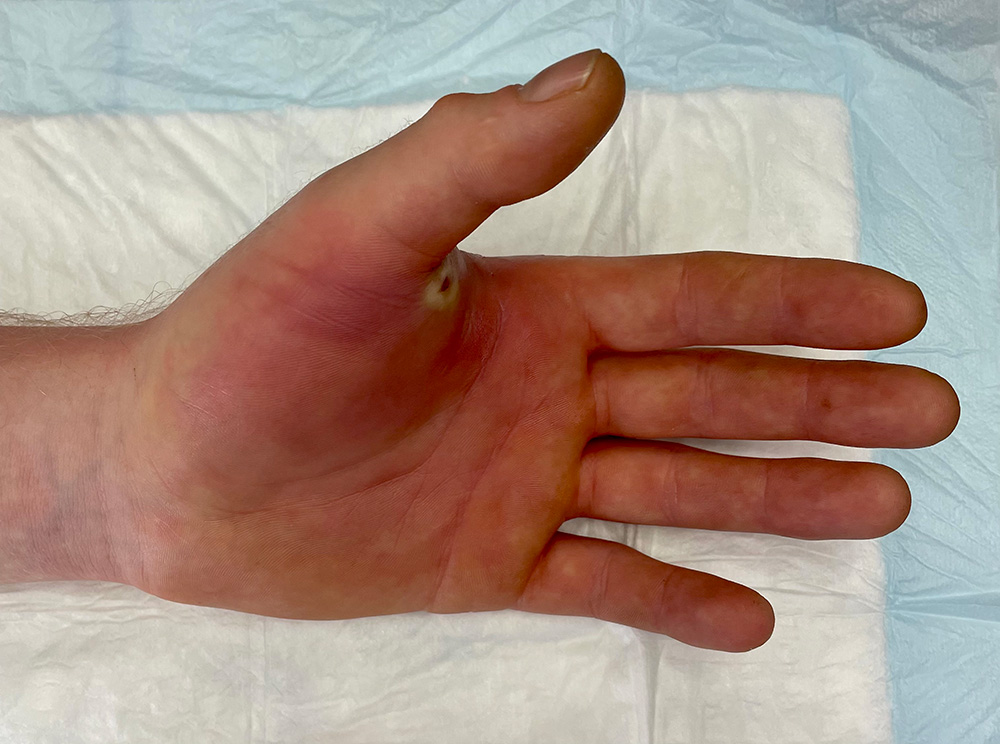 Photographie de la main d’un patient ayant attendu 3 jours avant de consulter à la suite d’une plaie de 3 mm par couteau à la base du pouce ; on note la présence d’une inflammation extrêmement importante et diffusée au reste de la main et à l’avant-bras, signant une surinfection grave de la plaie