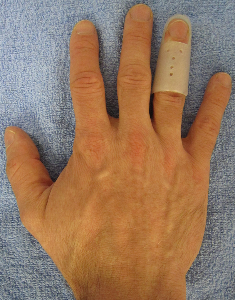 exemple d’attelle pour mallet finger