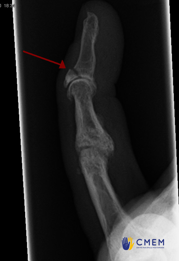 radiographie d’un mallet finger osseux