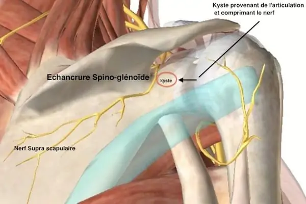 Introduction et Définition du Nerf Supra-scapulaire à l'Épaule Introduction et Définition du Nerf Supra-scapulaire à l'Épaule